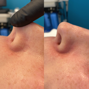 IPL Nose Veins before & after