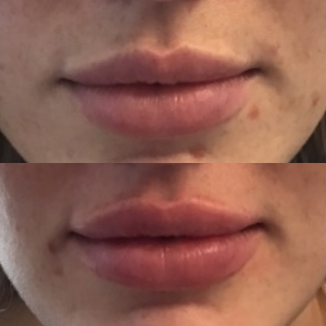 Restylane Kysse before & after