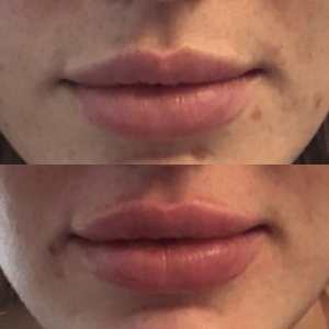 Restylane Kysse before & after