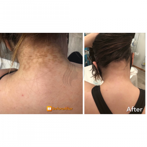 Advanced Corrective Peel Before & After