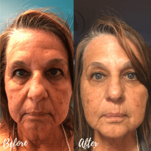 Botox, Filler & Threads Before & After