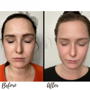 Cosmelan Peel Before & After