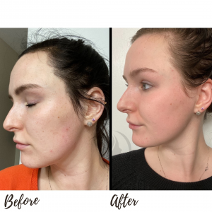 Cosmelan Peel Before & After