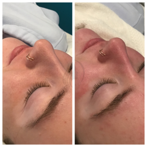 Hydrafacial before & After
