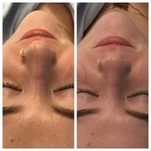 Hydrafacial before & After
