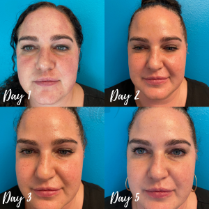 IPL Treatment Before & After