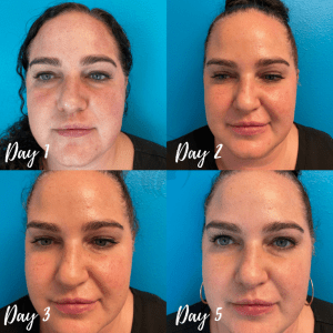 IPL Treatment Before & After