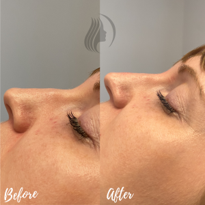 Nose Filler Before & After