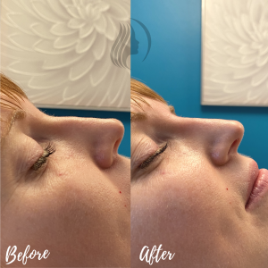 Nose Filler Before & After