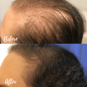 PRP Hair Restoration