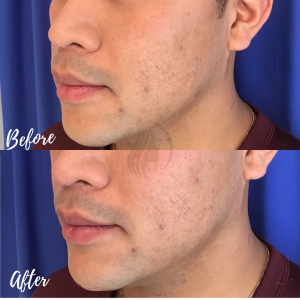 Jawline contouring with filler and botox