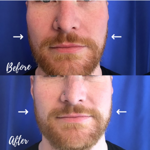 Jawline contouring with filler and botox