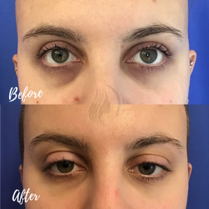 Under eye filler and botox
