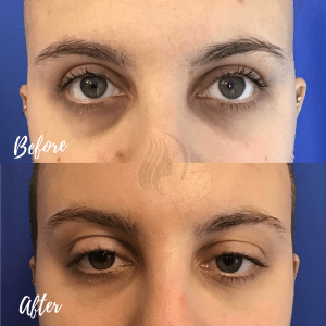 Under eye filler and botox