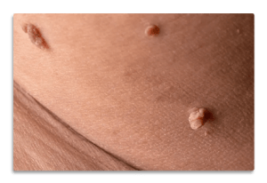 skin tags