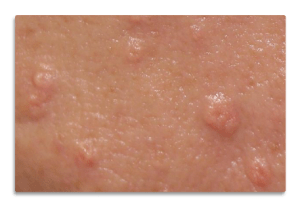 sebaceous gland hyperplasia