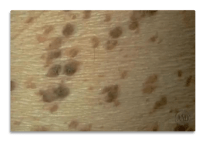 sebaceous kerratoses