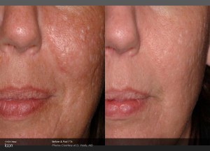 Woman's face before and after laser scar reduction