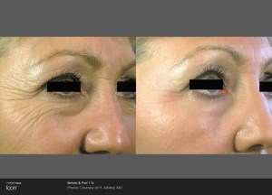 Woman's face after skin resurfacing