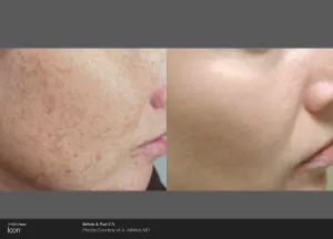 Woman's face before and after discoloration treatment