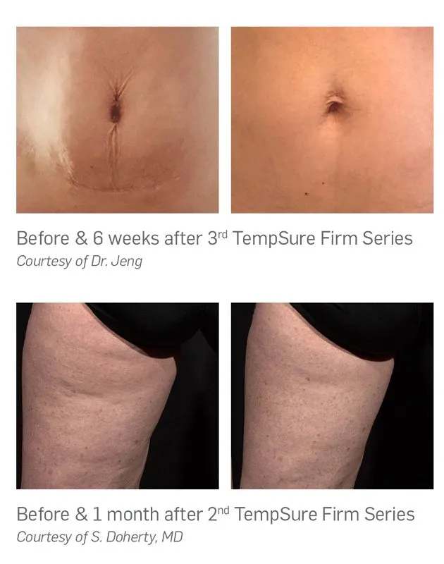 Tempsure before and after examples