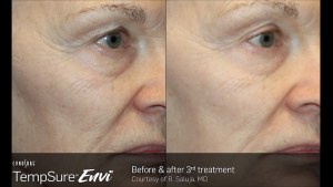 Woman's face before and after TempSure Envi