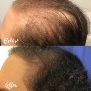 PRP hair restoration