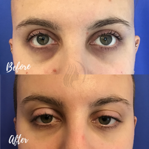 Botox & Filler