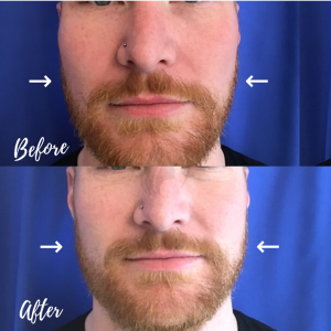 Botox & Filler