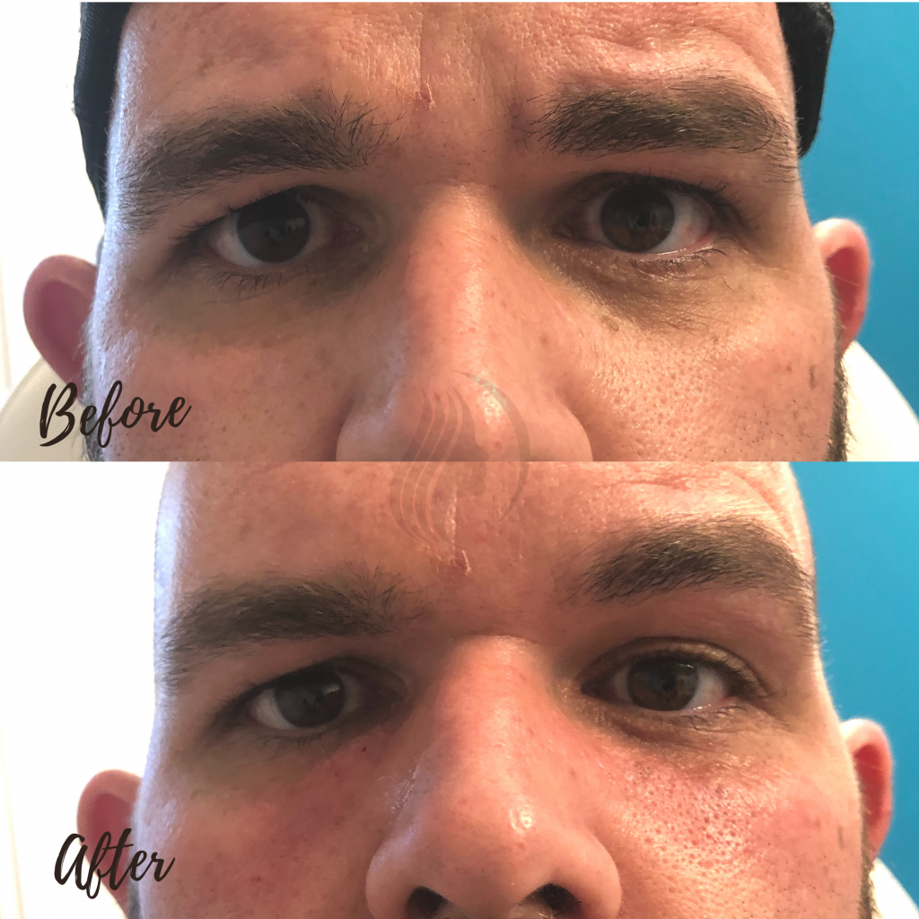 Under the eye filler for tear troughs