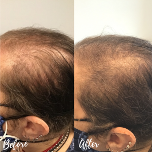 PRP for hair loss