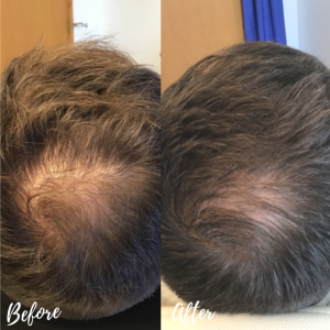 PRP for hair loss after 4 treatments