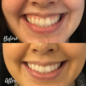 Neuromodulator for gummy smile